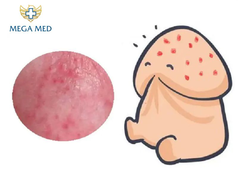 Quy đầu xuất hiện viêm mủ